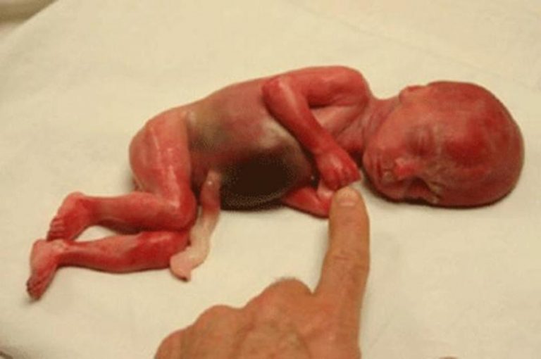 W USA jest coraz mniej lekarzy aborcjonistów